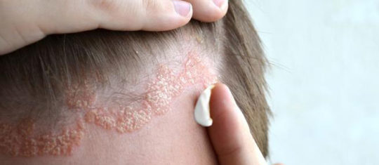 Meilleures crèmes psoriasis